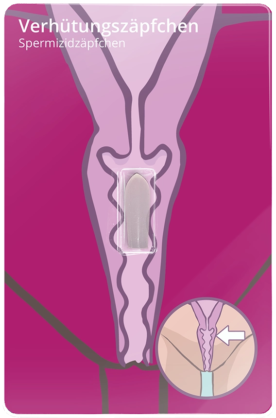 Verhütungsmethode: Vaginalzäpfchen Verhütungsmethode: Vaginalzäpfchen